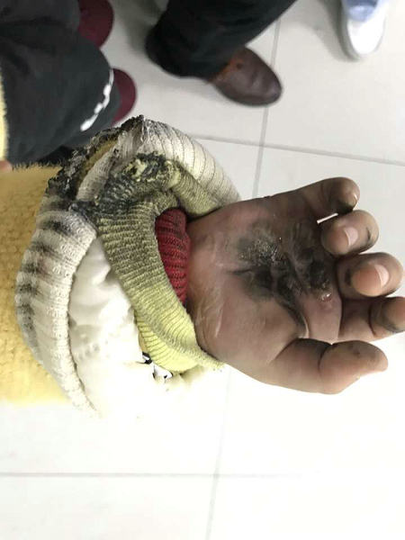 渭南市妇幼保健院急诊科今年春节就接诊了一名放炮竹被炸伤手的患儿和