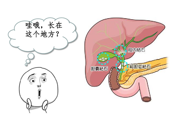 胆结石切除胆囊后,会变"胆"小吗?